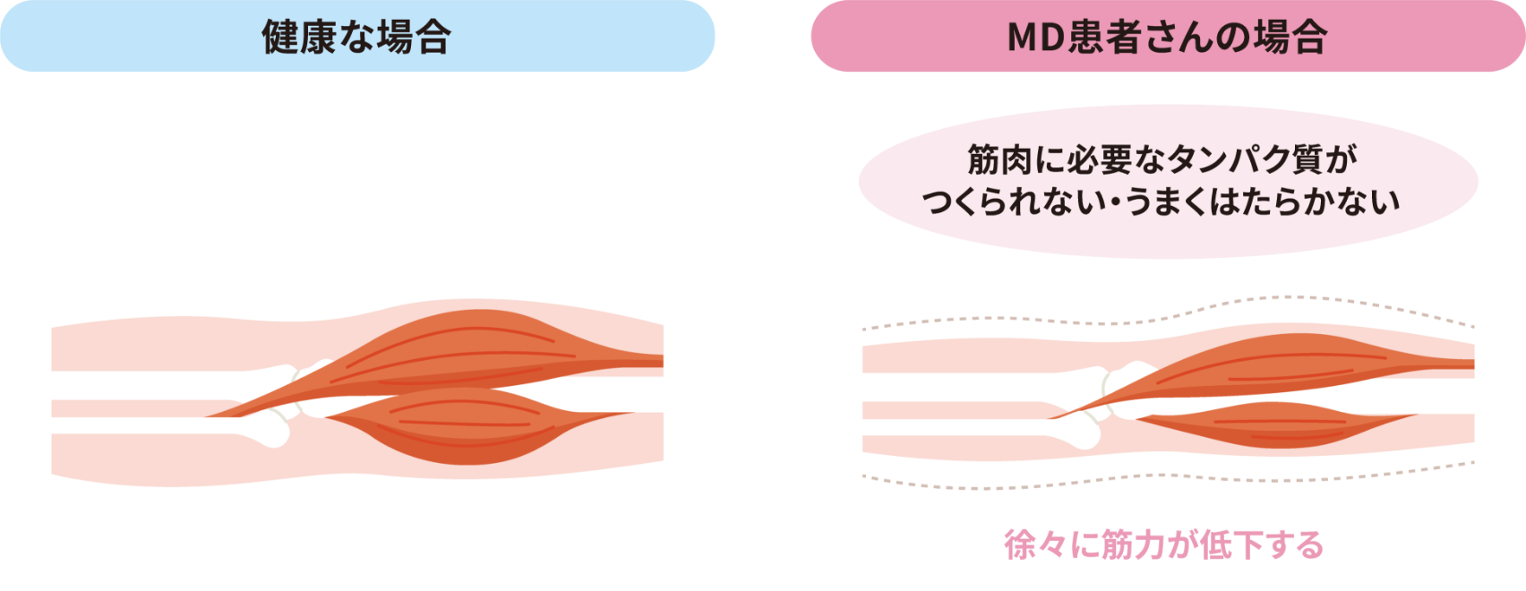 筋ジストロフィーの仕組みを示す図